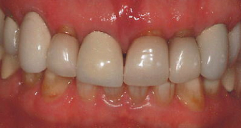Teeth whitening before treatment